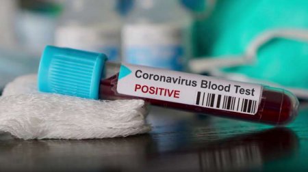 Azərbaycanda daha 78 nəfərdə koronavirus aşkarlandı